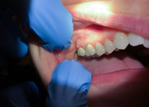 Best Dental Abscess Treatment in Ohioville, PA